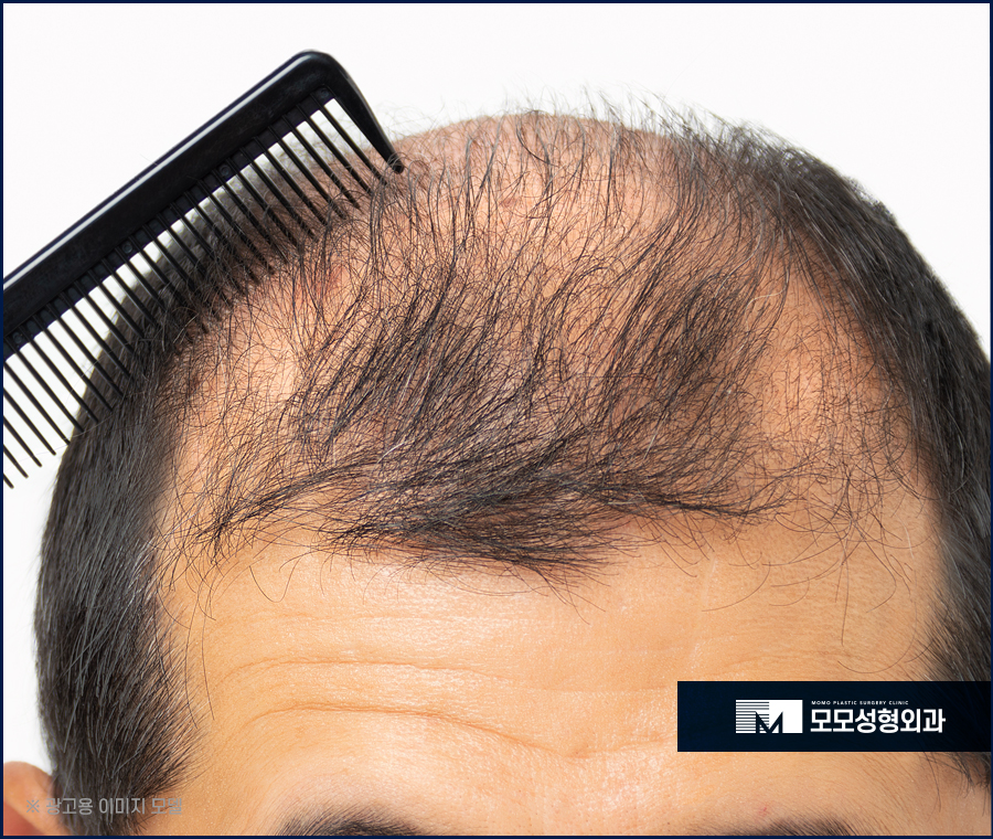 모발이식가격 산정되는 기준에 대해서 관련 이미지 2