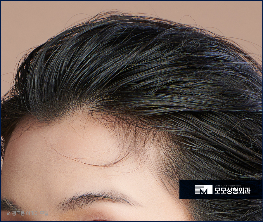 여성 헤어라인 모발이식 미모까지 완벽해 지는 효과 관련 이미지 7