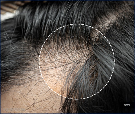 압구정 모발이식 외모 변화를 희망한다면 관련 이미지 5