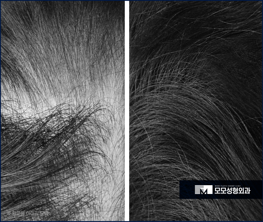 여자 옆머리 탈모 이유와 극복하고 채워가려면 관련 이미지 6