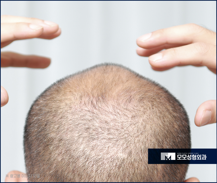 서울 모발이식 오랜 고민을 이겨내기 위한 선택 관련 이미지 9