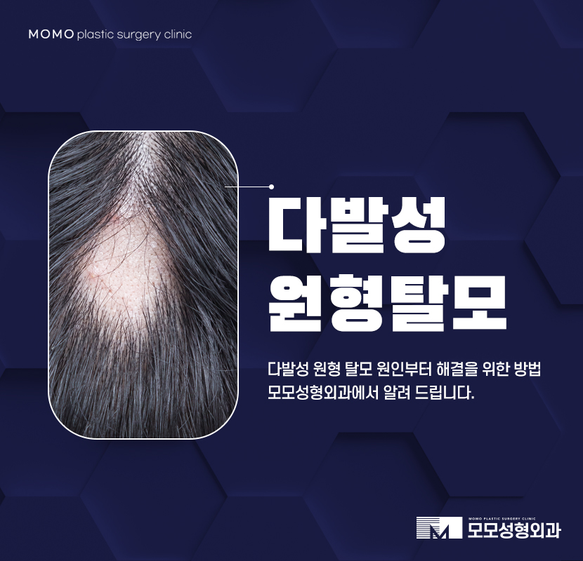 다발성원형탈모 원인부터 해결을 위한 방법 관련 이미지 1