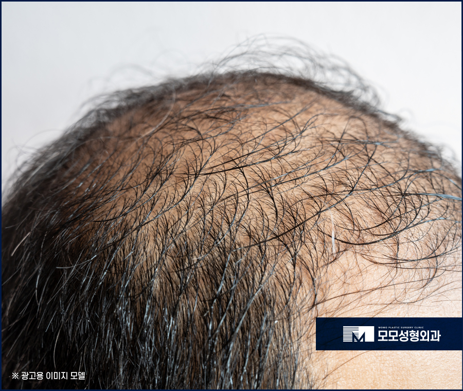 모발이식2주가 되면 어떤 변화가 찾아올까요 관련 이미지 2