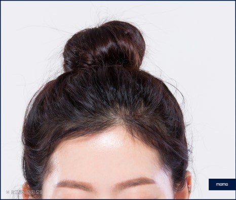 여자 m자 이마 헤어라인 모발이식으로 교정 관련 이미지 3