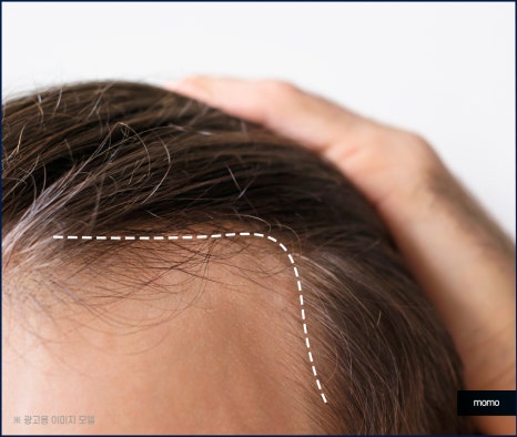 여자 m자 이마 헤어라인 모발이식으로 교정 관련 이미지 10