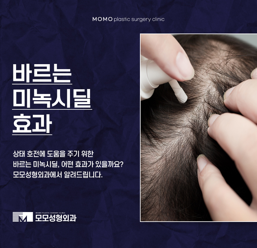 바르는미녹시딜효과 호전에 도움이 될까 관련 이미지 1