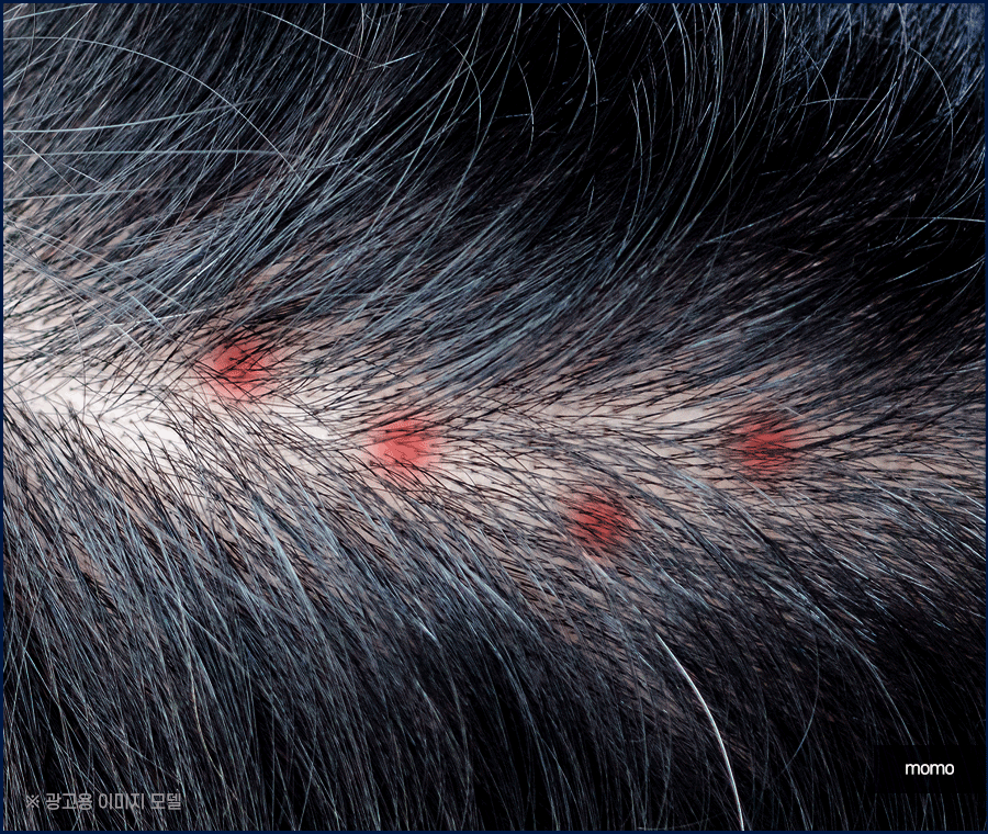 두피피딱지 원인 및 올바른 케어 방법은? 관련 이미지 6