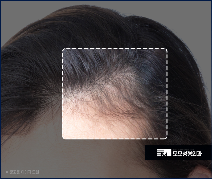 M자 모발이식 비용과 금액대가 달라지는 이유 관련 이미지 2