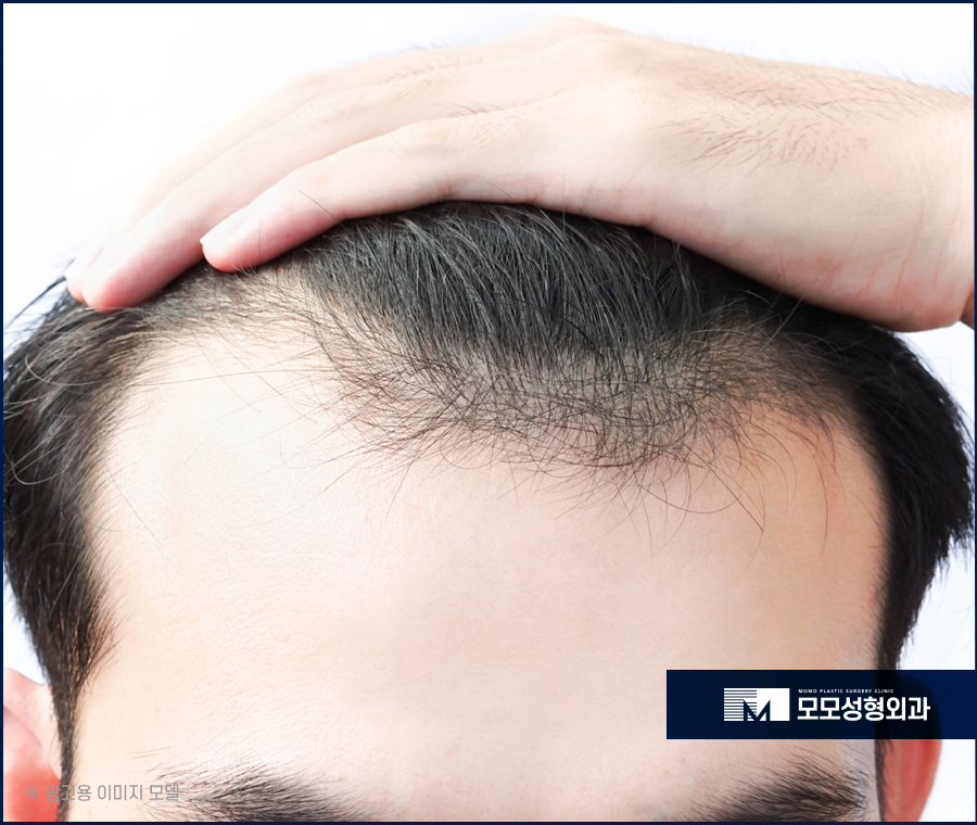 신사m자탈모치료 자연스럽게 보강하는 관련 이미지 4