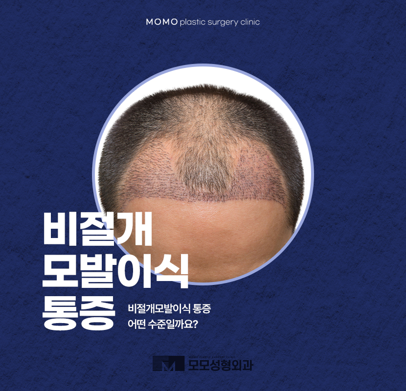 비절개모발이식통증 정도와 수준에 대해 관련 이미지 1