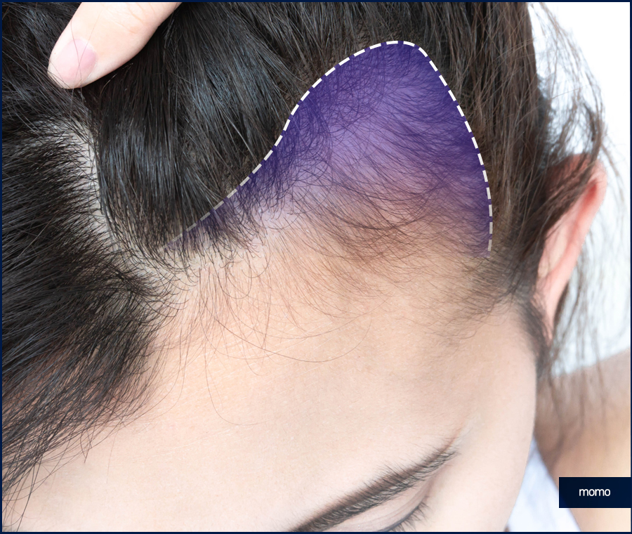 M자모발이식비용 가격 탈모 탈출을 위한 관련 이미지 7