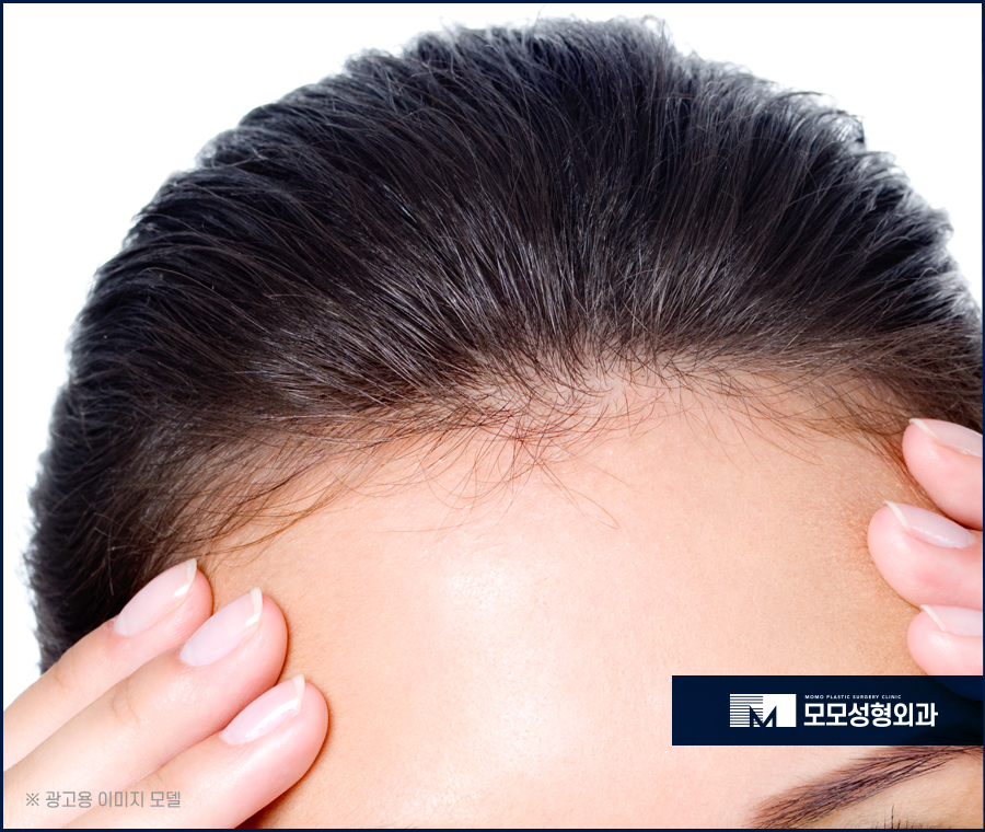 이마축소술 자연스럽게 채워가고 싶다면 관련 이미지 6