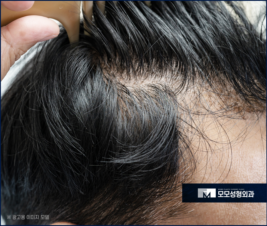 강남역 모발이식 빈 곳을 채우며 풍성하게 관련 이미지 6
