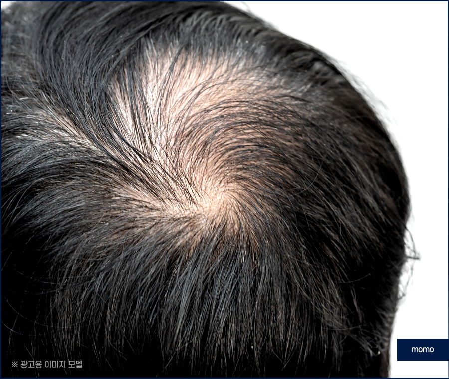 모발이식 후 운동 언제부터 하는게 좋을까요 관련 이미지 4