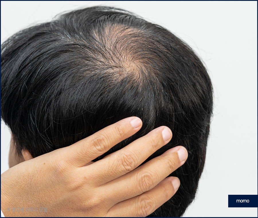 모발이식 생착률 극대화 하려면 관련 이미지 3