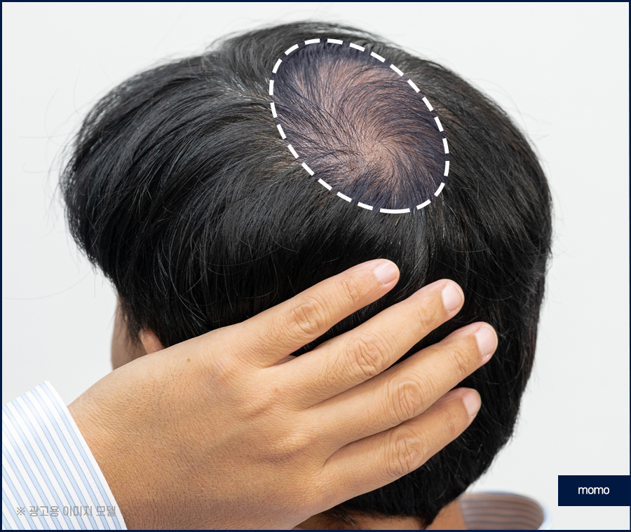 스트레스성 원형탈모를 유발하는 원인은 관련 이미지 8
