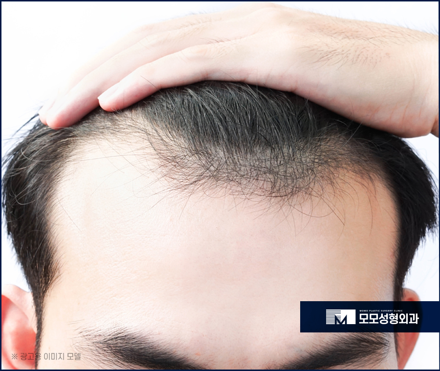 모발이식500모 소량으로 가볍게 보강하기 위한 관련 이미지 2