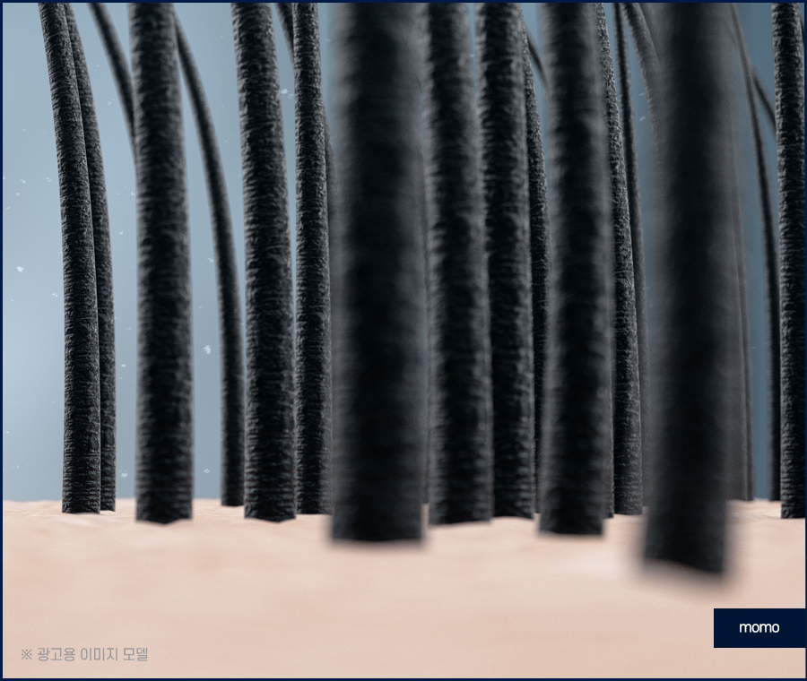 모발이식 생착률 기준짓는 요소들은 무엇일까 관련 이미지 3