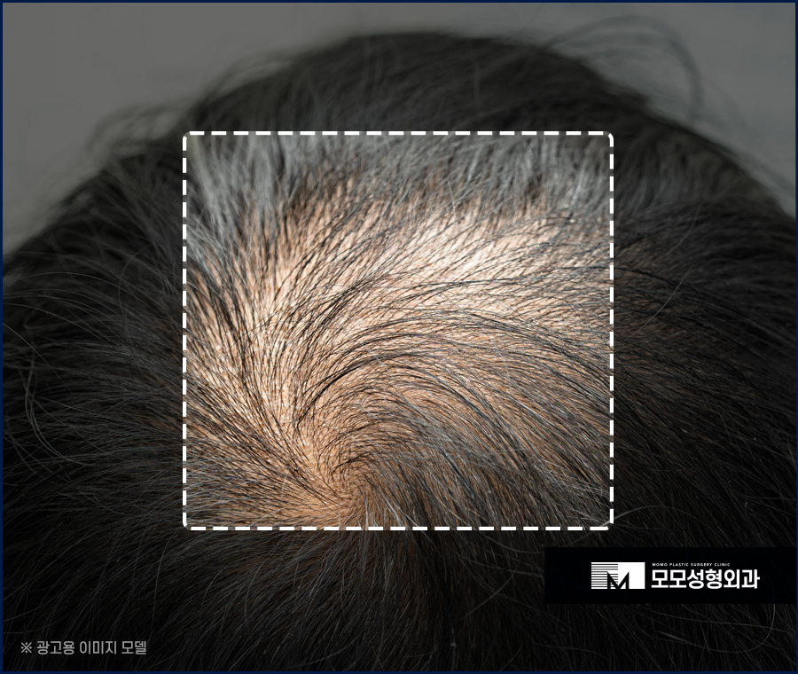 모발이식 삭발이 싫다면 노컷으로 부담을 줄여서 관련 이미지 4