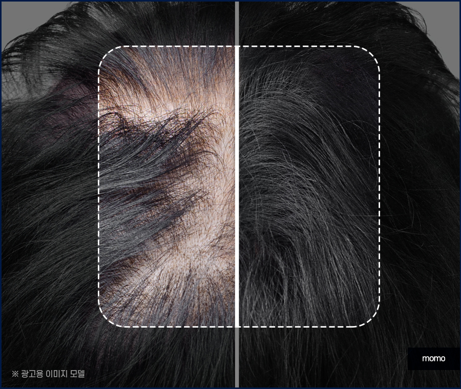 모발이식 절개 비절개 방법을 비교 분석해 가며 관련 이미지 5