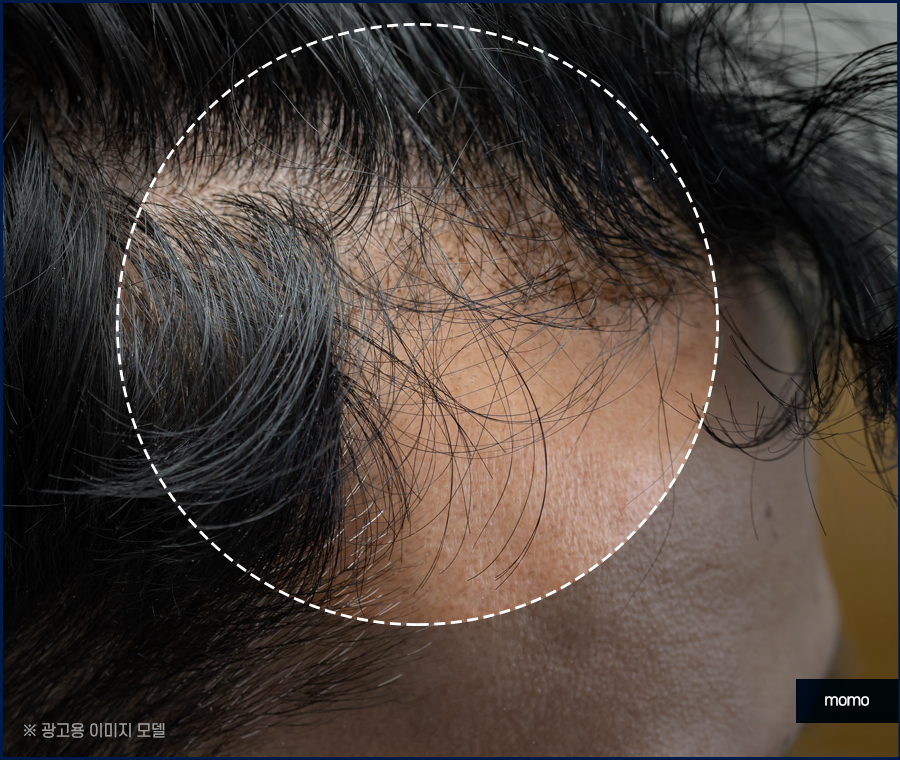m자탈모초기 현상과 빠르게 대처하면 좋은 포인트는 관련 이미지 2