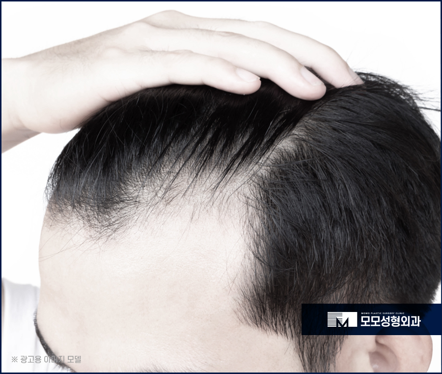 안드로겐성탈모 원인과 개선을 위한 방안은 관련 이미지 2