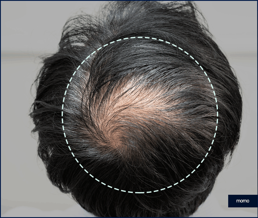 모발이식 3000모 비용 차이나는 이유 및 방법 관련 이미지 11