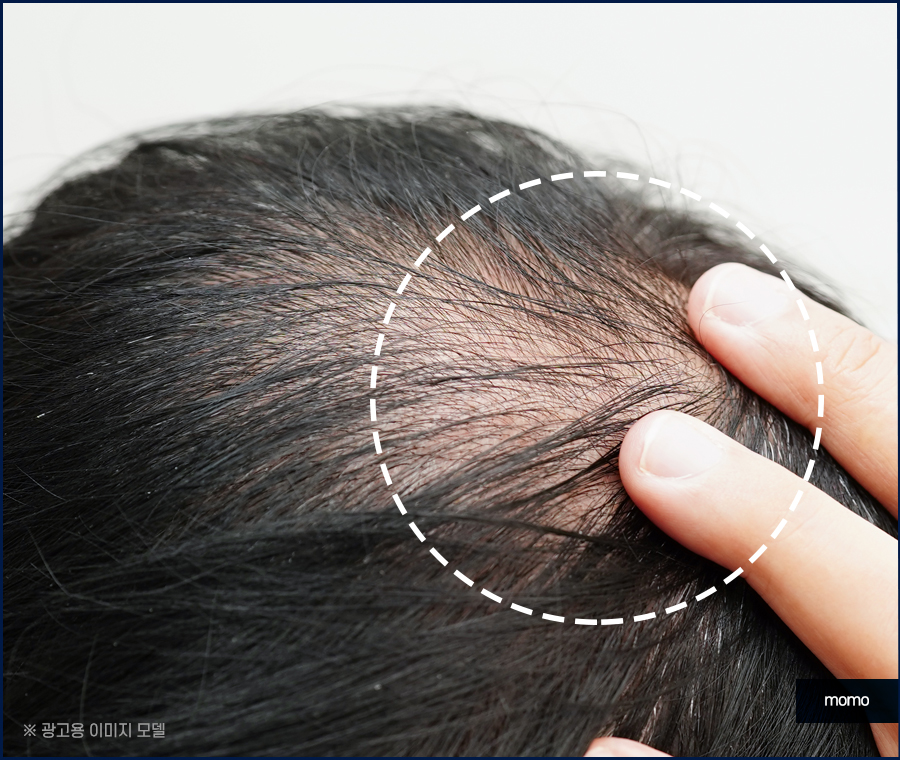 모발이식 후기 비교하며 섬세한 분석까지 해야만 관련 이미지 9
