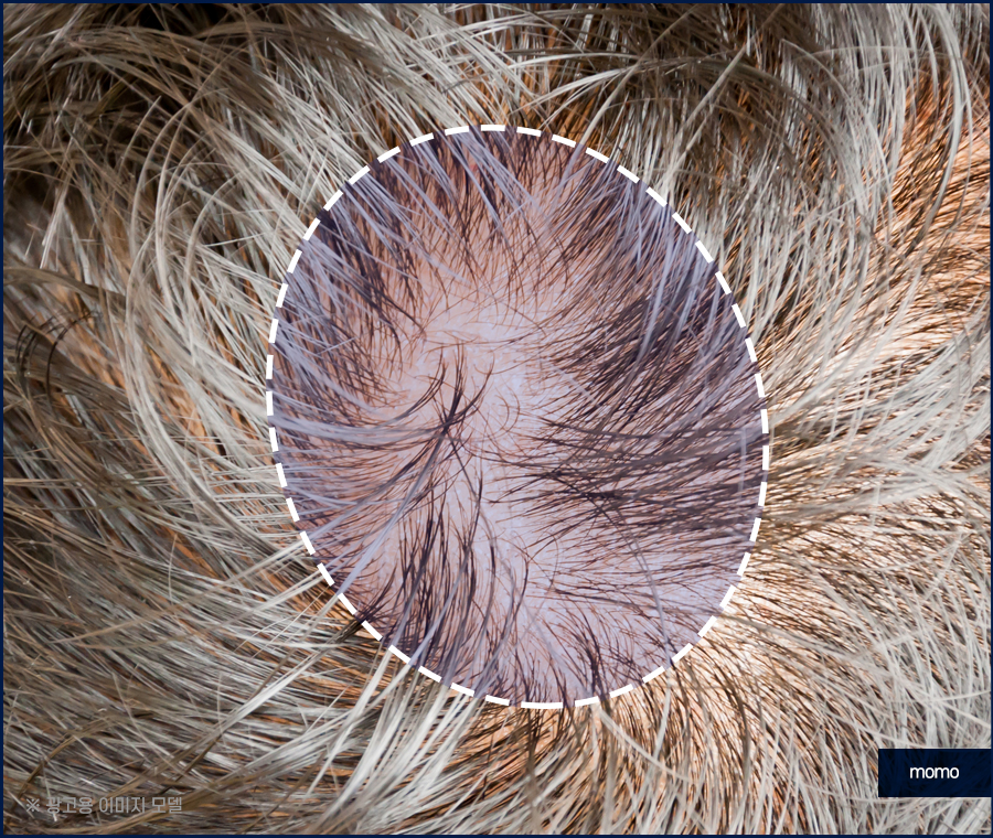 모발이식재수술 원인 파악을 먼저 관련 이미지 9