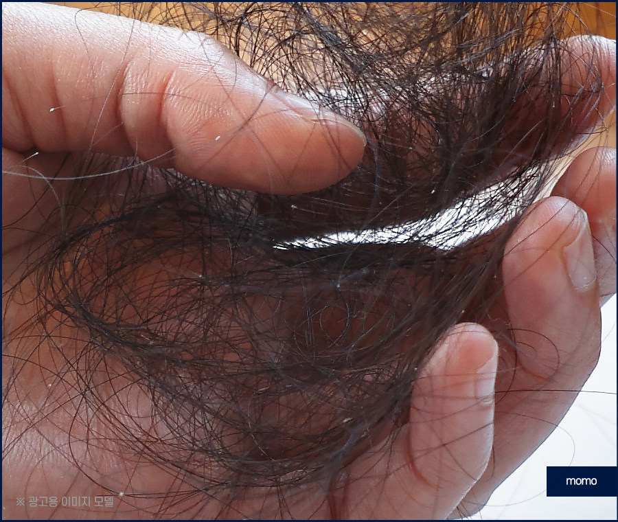 모발이식재수술 원인 파악을 먼저 관련 이미지 2