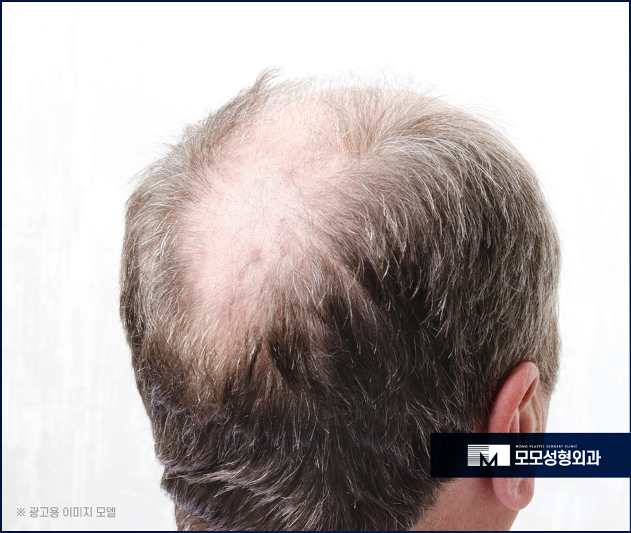 신사동 모발이식 헤어스타일을 자유롭게 연출하기 위한 관련 이미지 6