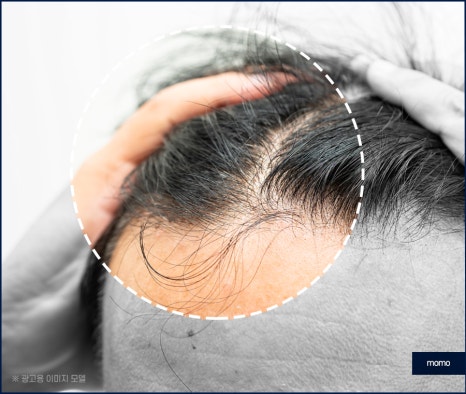 모발이식3000모비용 차이나는 이유 관련 이미지 5