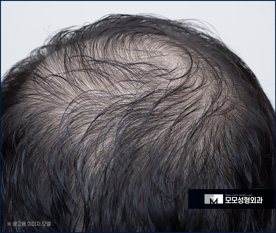 신사모발이식 단순히 채운다는 개념을 넘어 관련 이미지 4