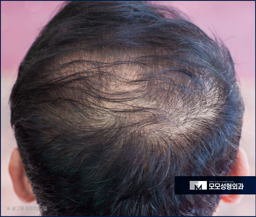 모발이식명의 효과를 위해 찾고 있다면 관련 이미지 3