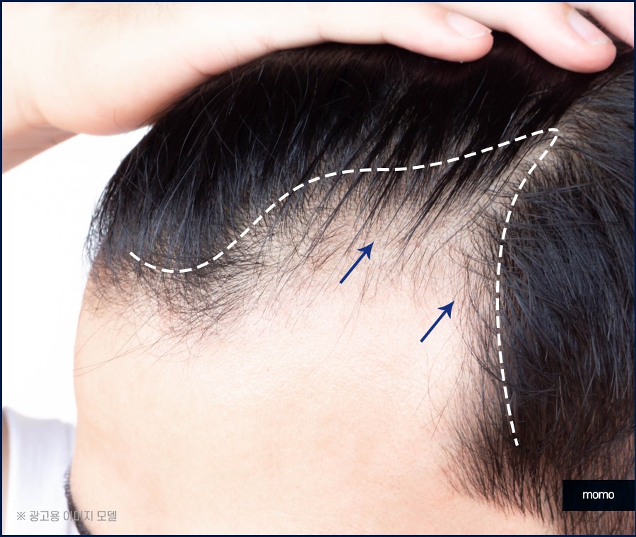 모발이식병원추천 선택 시 꼭 체크할 사항 3가지 관련 이미지 6