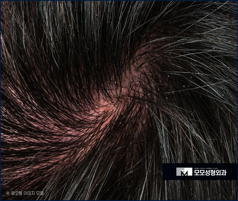 미녹시딜 5% 효과와 사용 전 알아두어야 할 점 관련 이미지 10