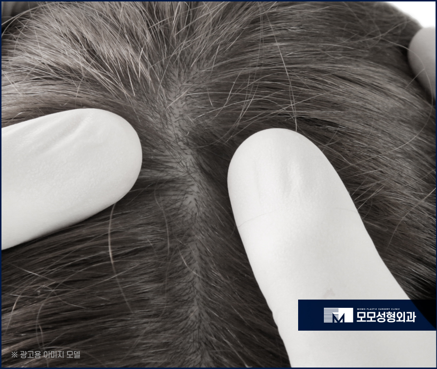 모발이식 6개월 차 변화와 유의할 점에 대해서 관련 이미지 3