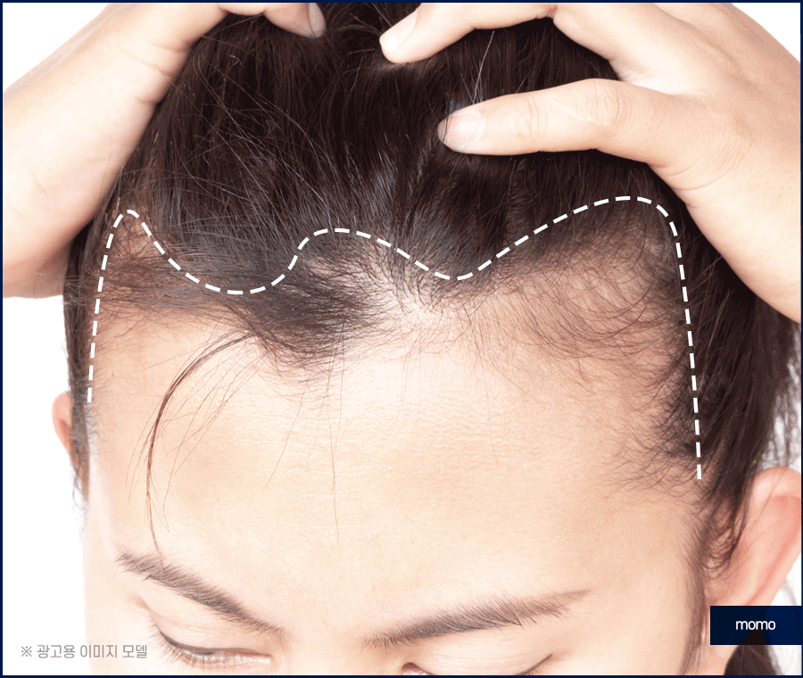 여자M자탈모 회복을 위한 맞춤 솔루션 관련 이미지 5