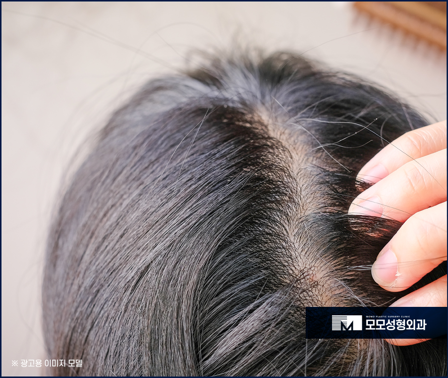 정수리탈모초기 미리 알고 초기 대응으로 관련 이미지 2