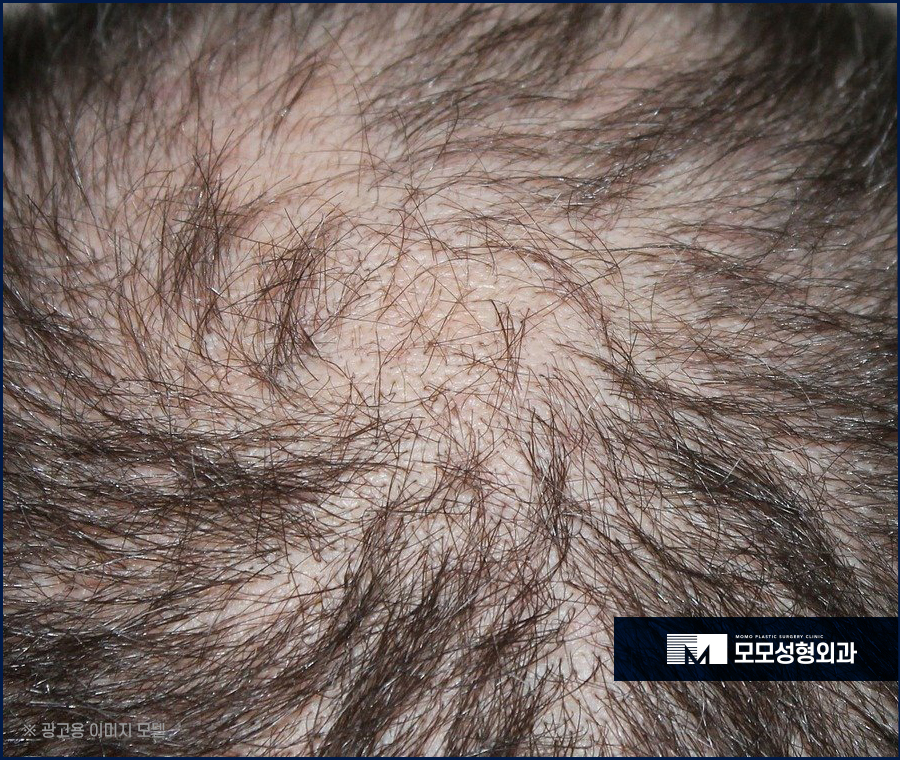 비절개모발이식후기 선택을 하기 위해 관련 이미지 3