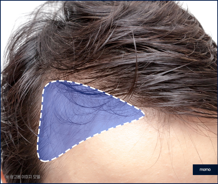 m자탈모초기 빠른 대처를 이뤄낸다면 관련 이미지 10