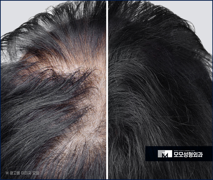 이승아원장 비절개 노컷 모발이식 관련 이미지 7