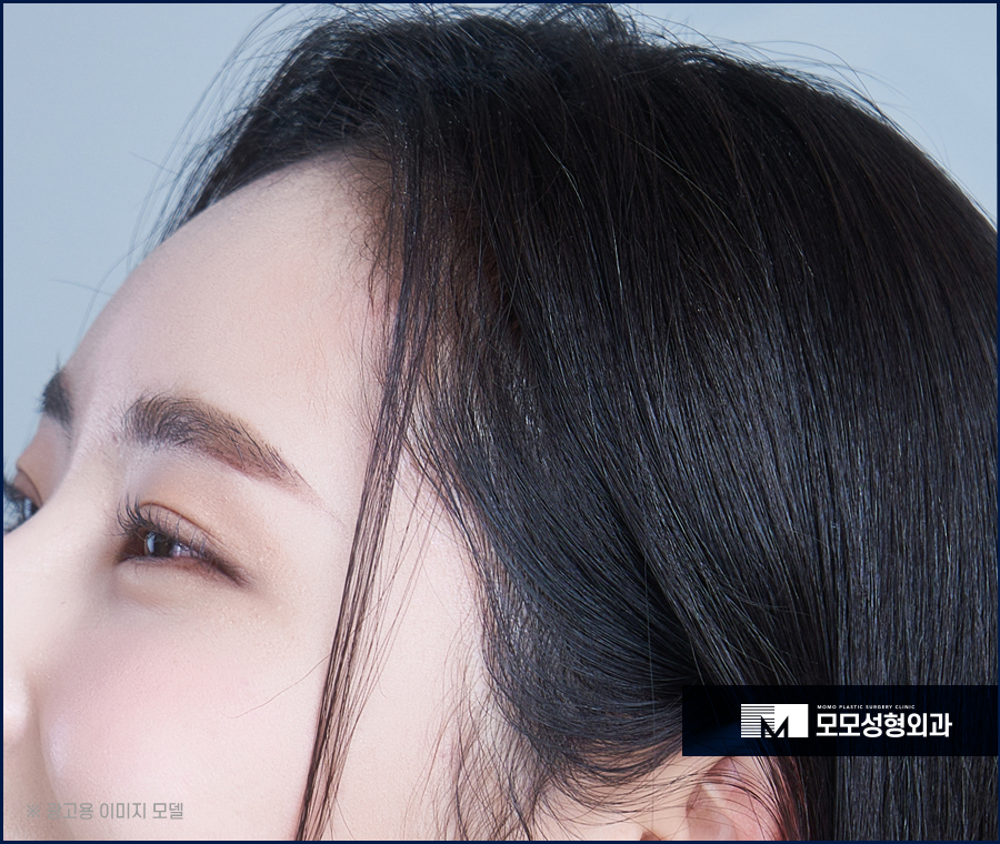 여성 헤어라인 모발이식 미모까지 완벽해 지는 효과 관련 이미지 2