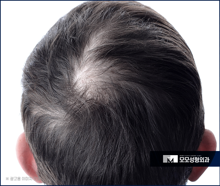 비절개모발이식비용 예후까지 고려하는 관련 이미지 3