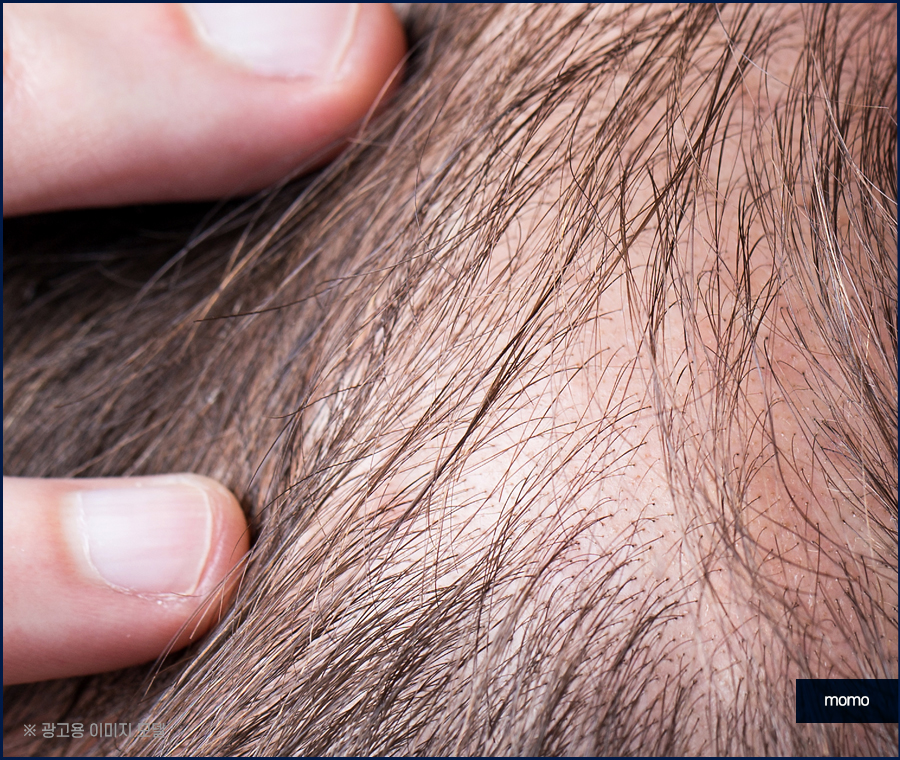 정수리 탈모 모발이식 섬세하게 채워가는 관련 이미지 6