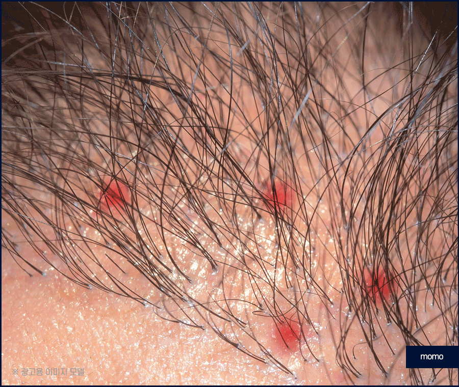 두피피딱지 원인 및 올바른 케어 방법은? 관련 이미지 8