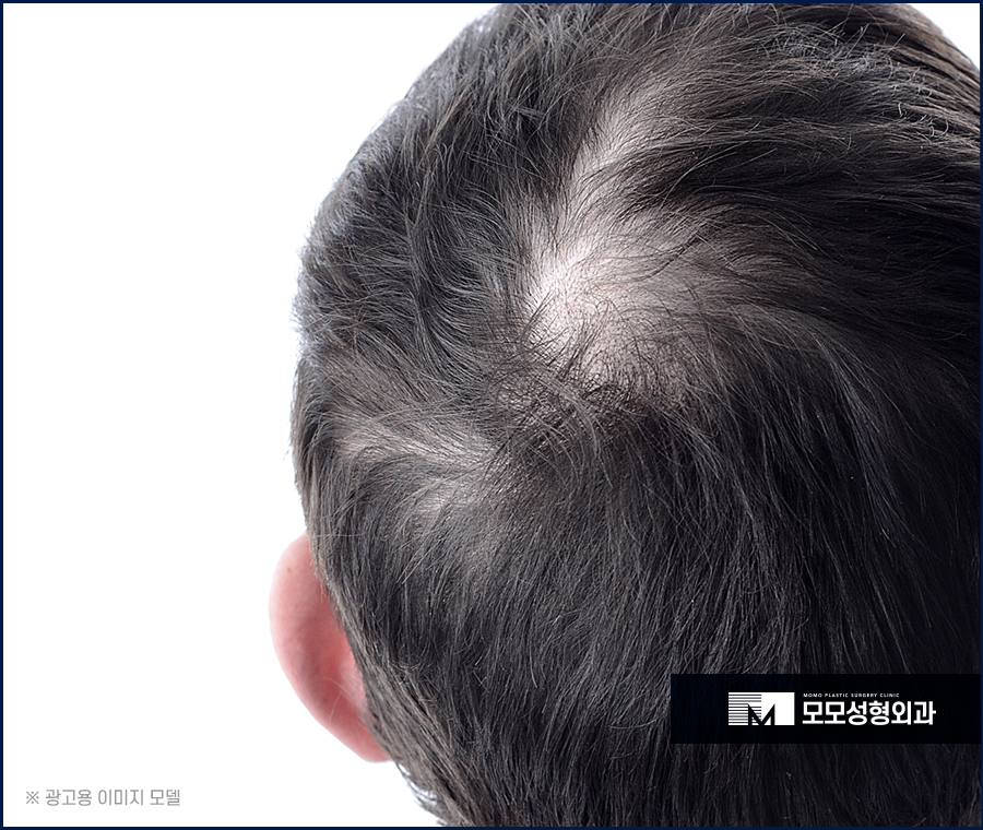 모발이식2달 차에 일어나는 달라짐에 대해서 관련 이미지 2