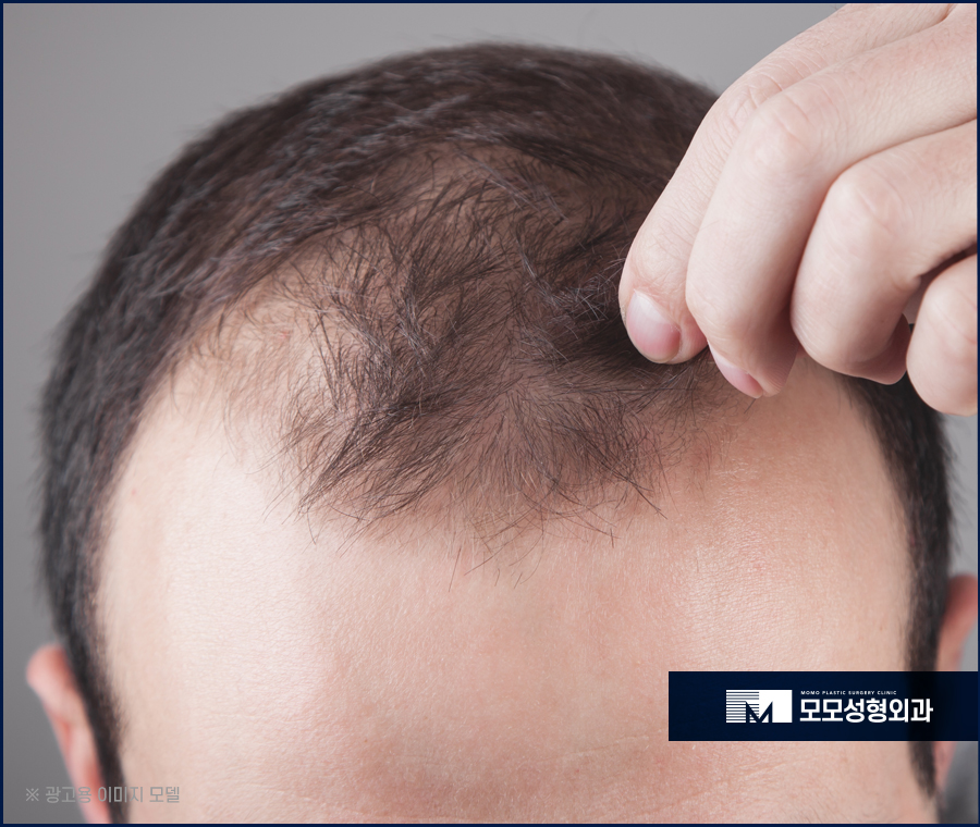 헤어라인모발이식비용 찾아볼 때 참고할 점은 관련 이미지 4