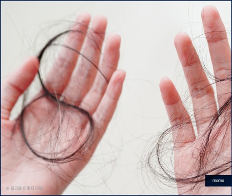 압구정역 모발이식 방법 및 생착률을 높이는 팁 관련 이미지 2