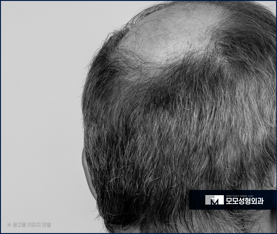 비절개모발이식가격 꼼꼼히 살펴보며 함께 체크할 점 관련 이미지 6